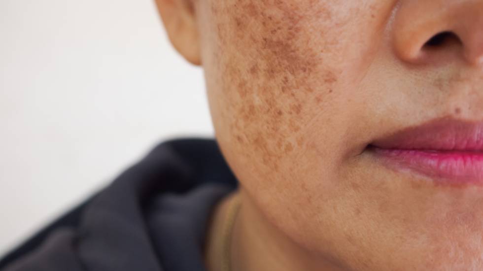 Ephelides Treatment Shepperton